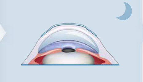 How to Prescribe Orthokeratology to Match Patients’ and Practitioners’ Needs